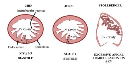 lv non compaction echo criteria|noncompaction cardiomyopathy criteria.